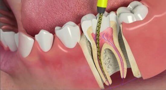Эндодонтическое лечение зубов