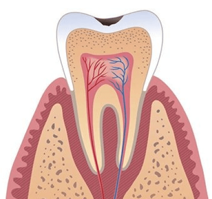 Восстановление зуба литой конструкции
